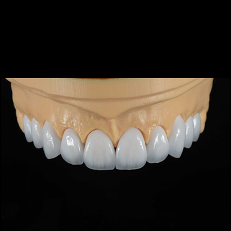 E-max Veneer