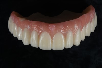 Akrilgyanta ideiglenes korona